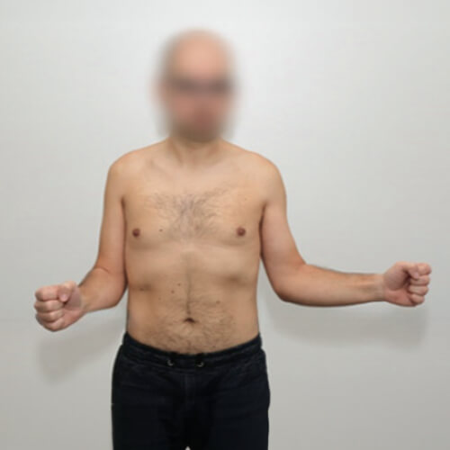 Immagine di persona con movimento limitato dalla capsulite adesiva