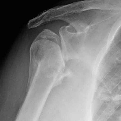 Radiografia di un caso di artrosi della spalla post traumatica