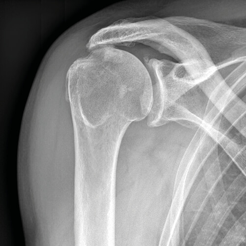Radiografia di un caso di artrosi della spalla da rottura massiva inveterata della cuffia dei rotatori