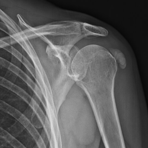 Radiografia di una tendinopatia calcifica della spalla