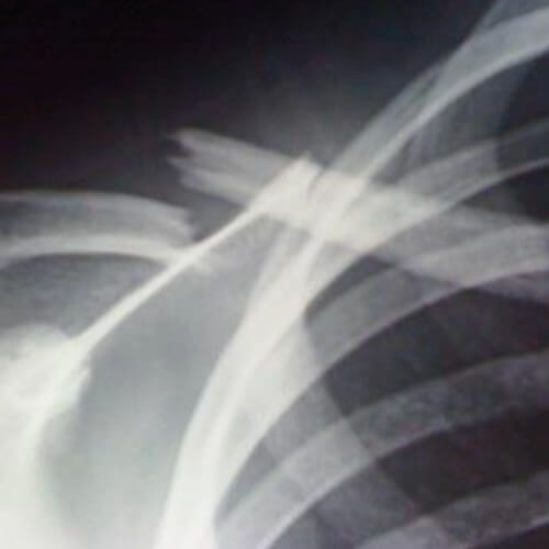 Radiografia di una frattura della clavicola