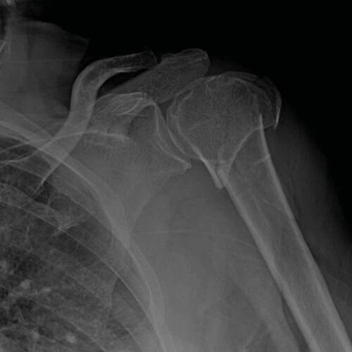 Radiografia di una frattura dell'omero prossimale