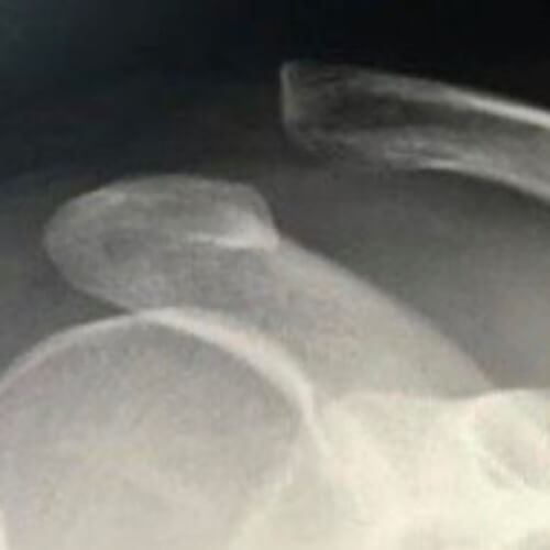 Radiografia di una lussazione acromion-claveare