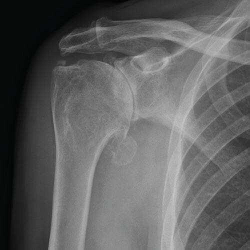Radiografia di un caso di artrosi della spalla primitiva concentrica