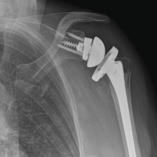 Radiografia di un caso di protesi inversa della spalla per riparazione della frattura dell'omero prossimale
