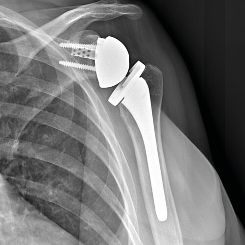Radiografia di un caso di protesi inversa della spalla