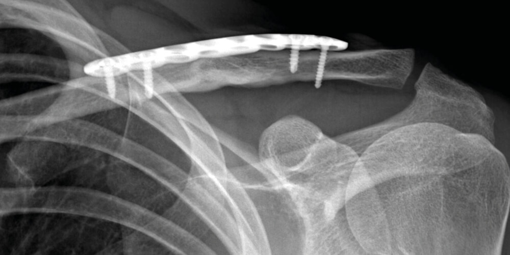Radiografia di un intervento di osteosintesi della clavicola