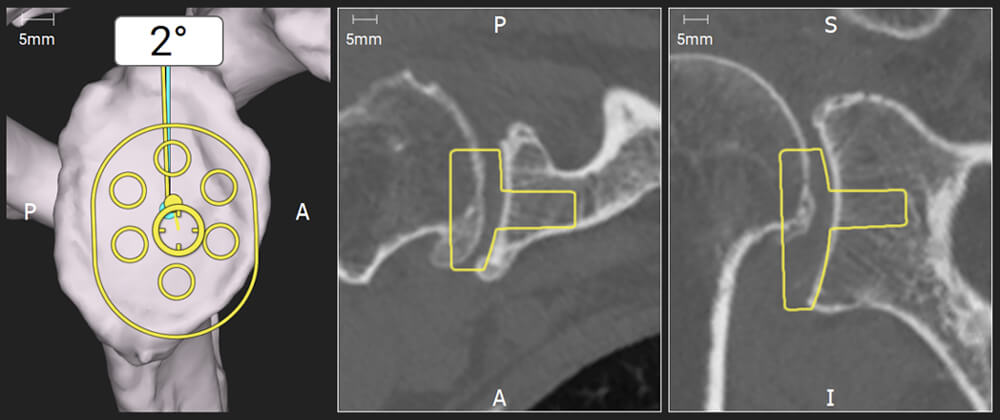 Navigazione intraoperatoria durante impianto di un componente protesico