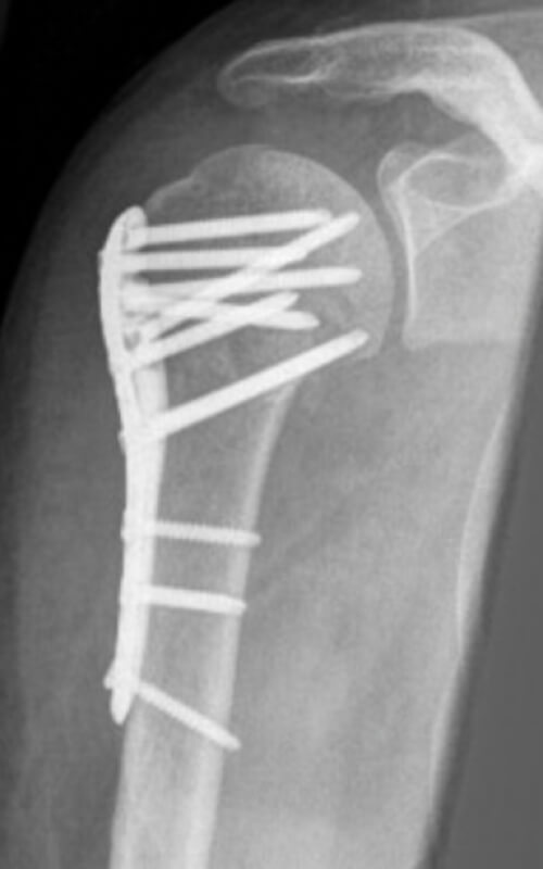 Radiografia di un intervento di osteosintesi dell'omero prossimale